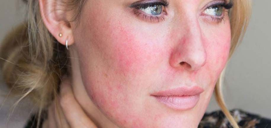 עור יבש ומגורה