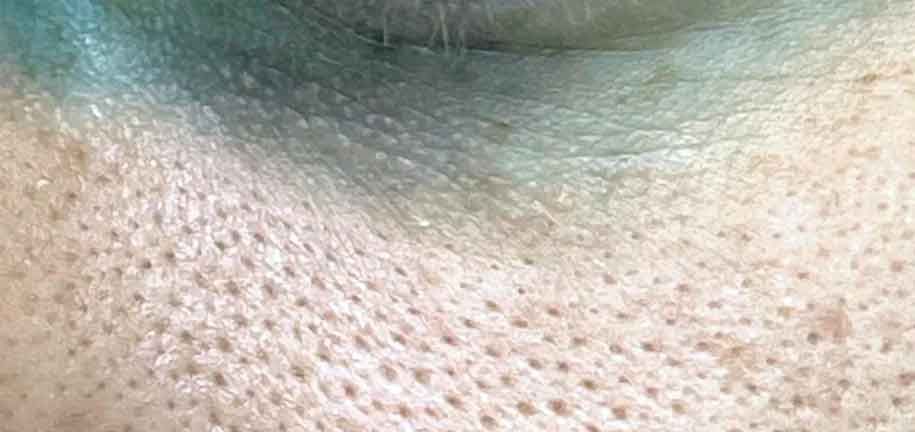 נקבוביות מורחבות בפנים