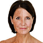 עור פגוע מהשמש