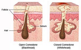 נקודות שחורות ונקבוביות